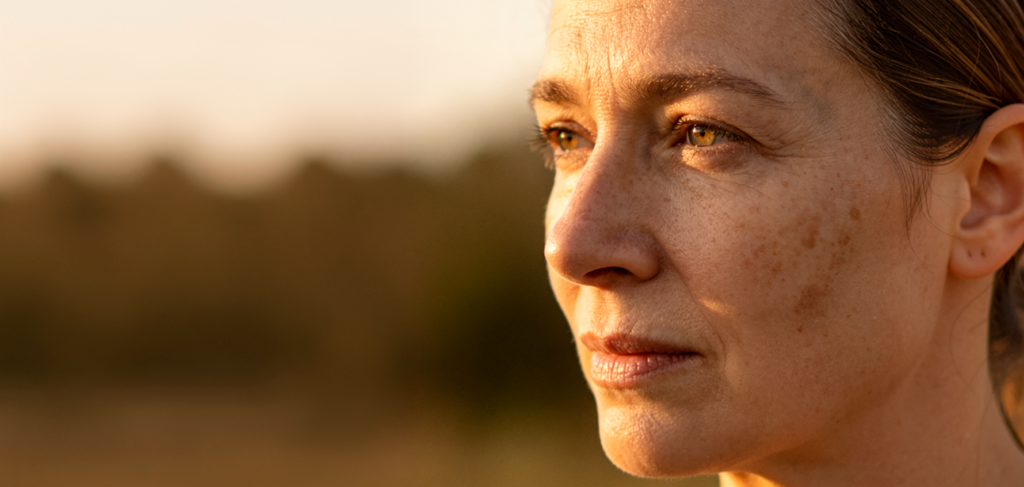 melasma