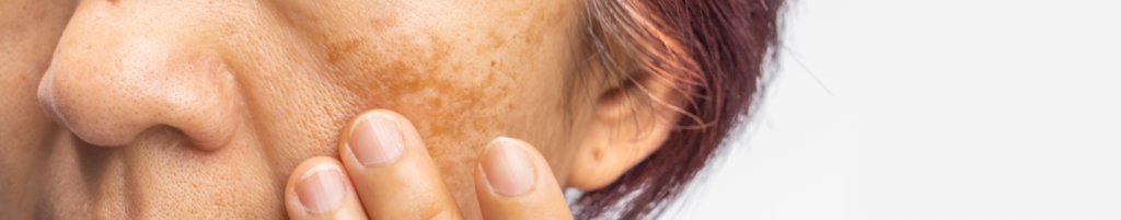 melasma